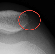 MPFL Bony Avulsion